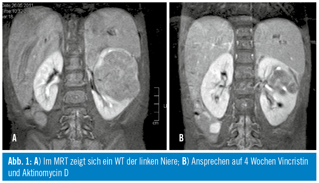 WilmsTumor State of the Art Spectrum Onkologie MedMedia